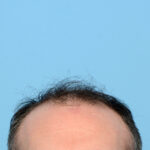 Fue Before and After | Dr. Jeffrey Wise