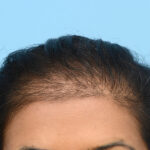 Fue Before and After | Dr. Jeffrey Wise