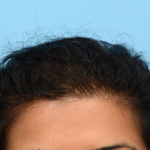 Fue Before and After | Dr. Jeffrey Wise