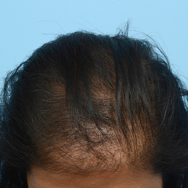 Fue Before and After | Dr. Jeffrey Wise