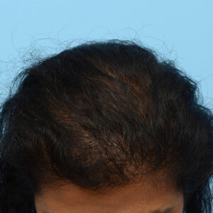 Fue Before and After | Dr. Jeffrey Wise