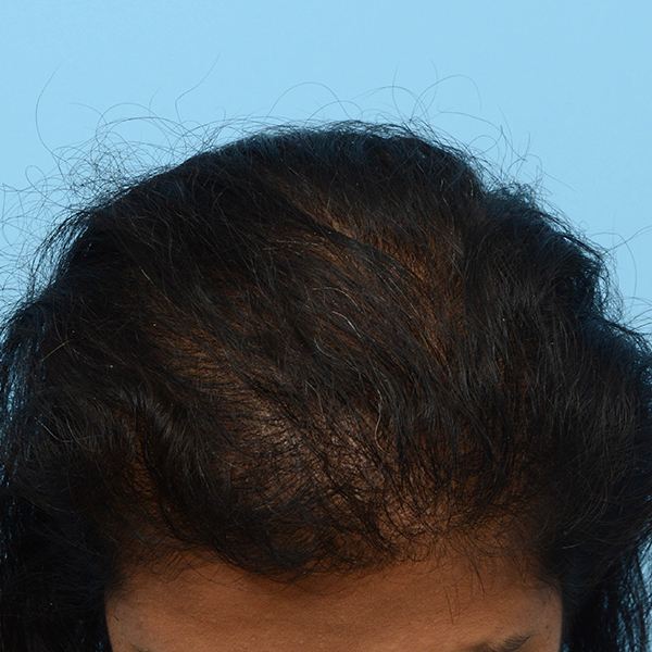 Fue Before and After | Dr. Jeffrey Wise