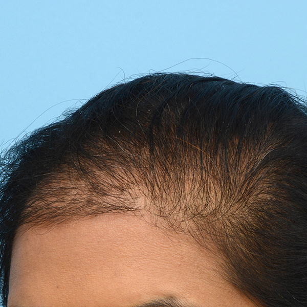 Fue Before and After | Dr. Jeffrey Wise