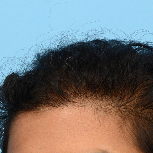Fue Before and After | Dr. Jeffrey Wise