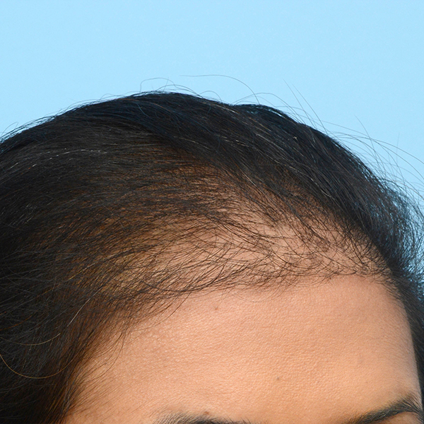 Fue Before and After | Dr. Jeffrey Wise