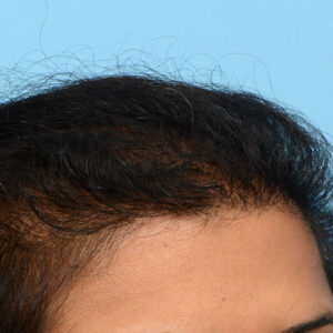 Fue Before and After | Dr. Jeffrey Wise