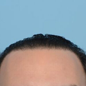 Fue Before and After | Dr. Jeffrey Wise