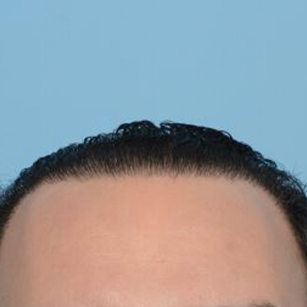 Fue Before and After | Dr. Jeffrey Wise