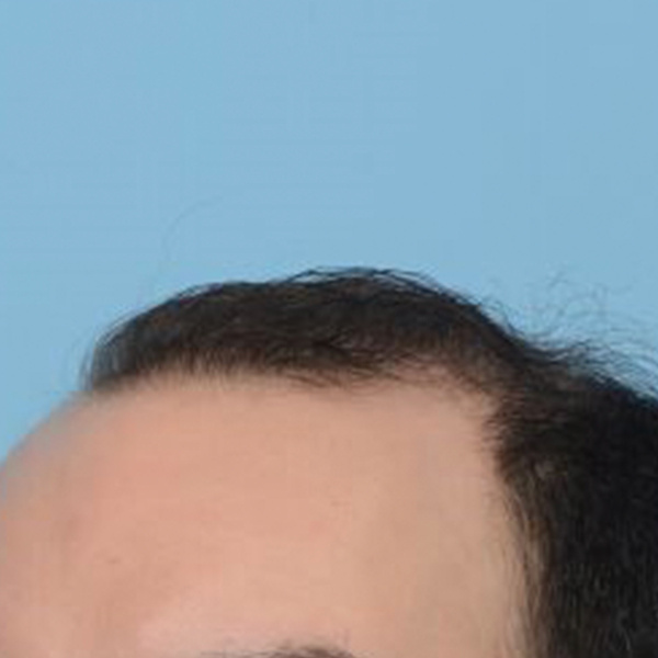 Fue Before and After | Dr. Jeffrey Wise