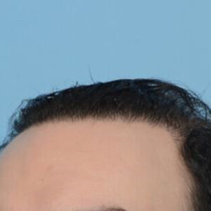 Fue Before and After | Dr. Jeffrey Wise