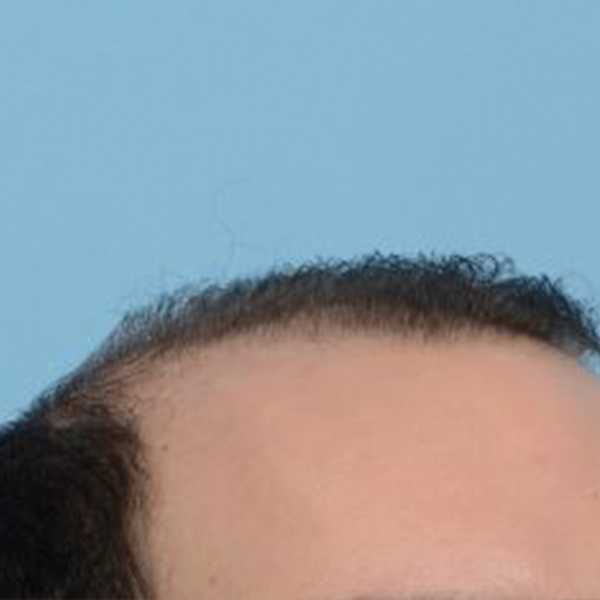 Fue Before and After | Dr. Jeffrey Wise