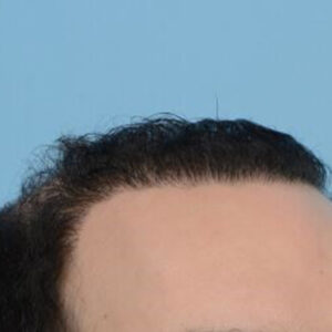 Fue Before and After | Dr. Jeffrey Wise