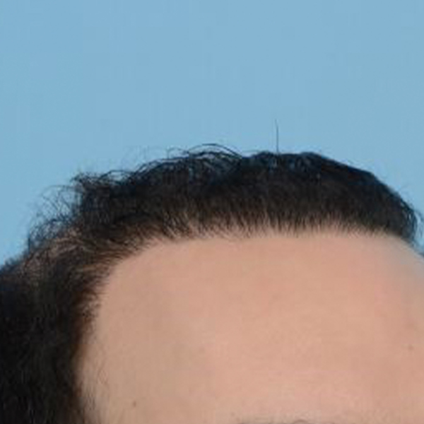 Fue Before and After | Dr. Jeffrey Wise