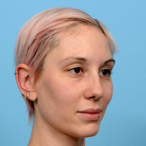 Fue Before and After | Dr. Jeffrey Wise