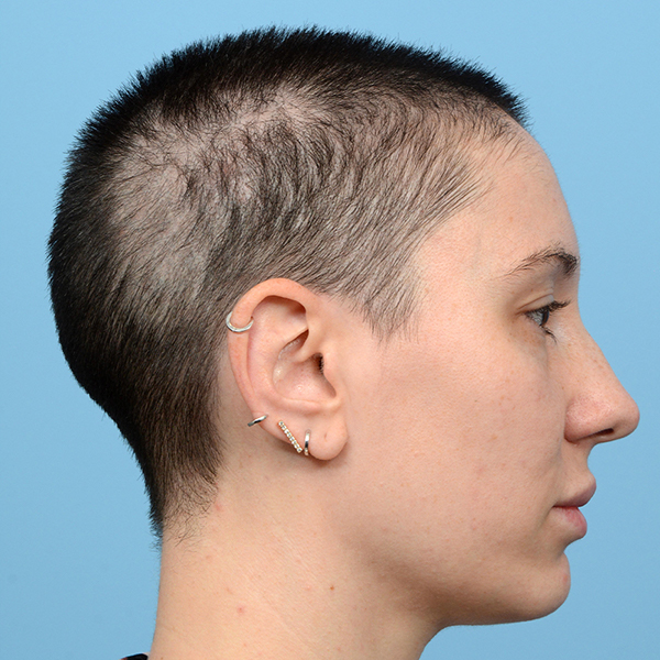 Fue Before and After | Dr. Jeffrey Wise