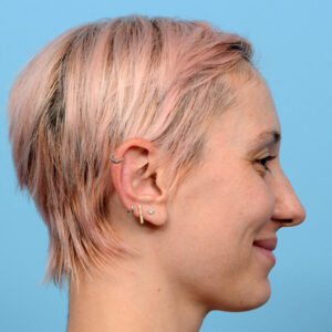 Fue Before and After | Dr. Jeffrey Wise