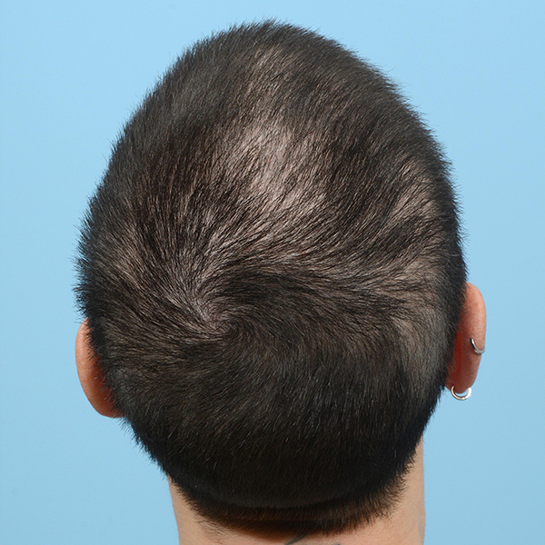 Fue Before and After | Dr. Jeffrey Wise