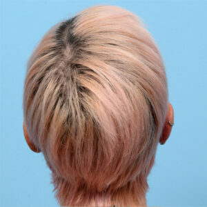 Fue Before and After | Dr. Jeffrey Wise