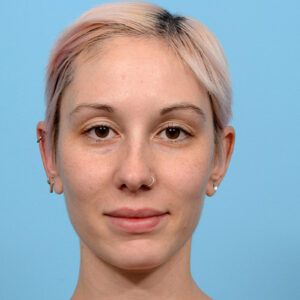 Fue Before and After | Dr. Jeffrey Wise