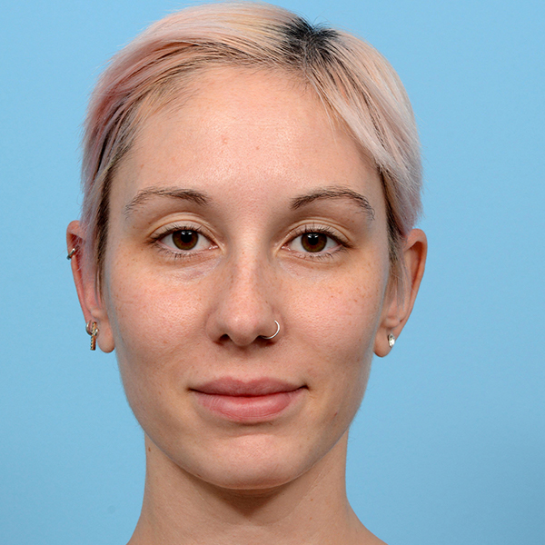 Fue Before and After | Dr. Jeffrey Wise