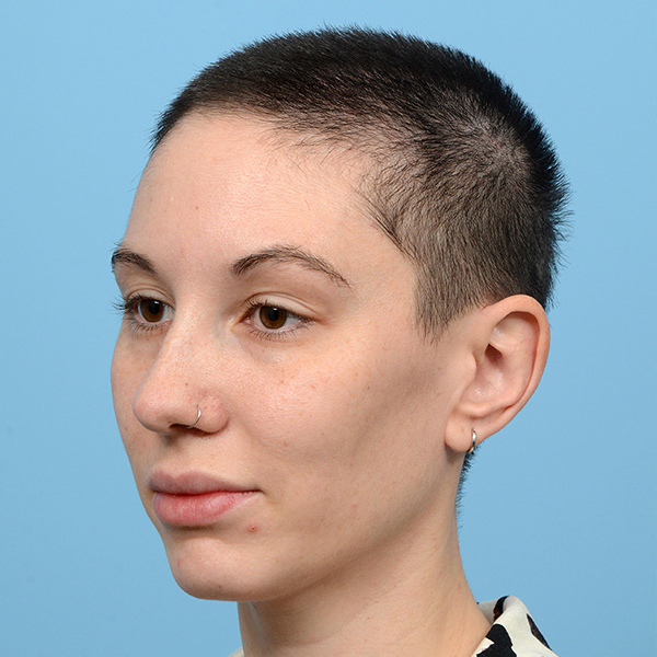 Fue Before and After | Dr. Jeffrey Wise