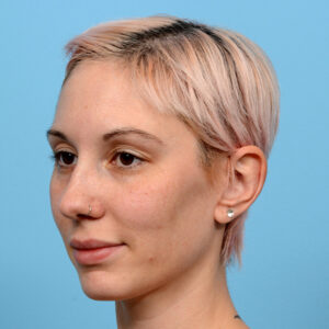Fue Before and After | Dr. Jeffrey Wise