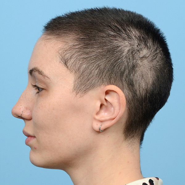 Fue Before and After | Dr. Jeffrey Wise