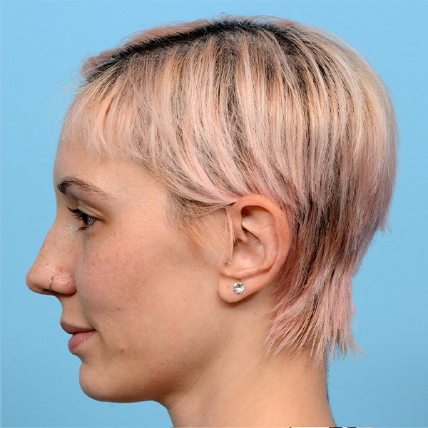 Fue Before and After | Dr. Jeffrey Wise