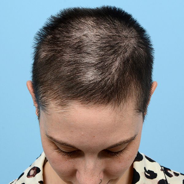 Fue Before and After | Dr. Jeffrey Wise