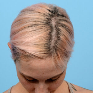 Fue Before and After | Dr. Jeffrey Wise