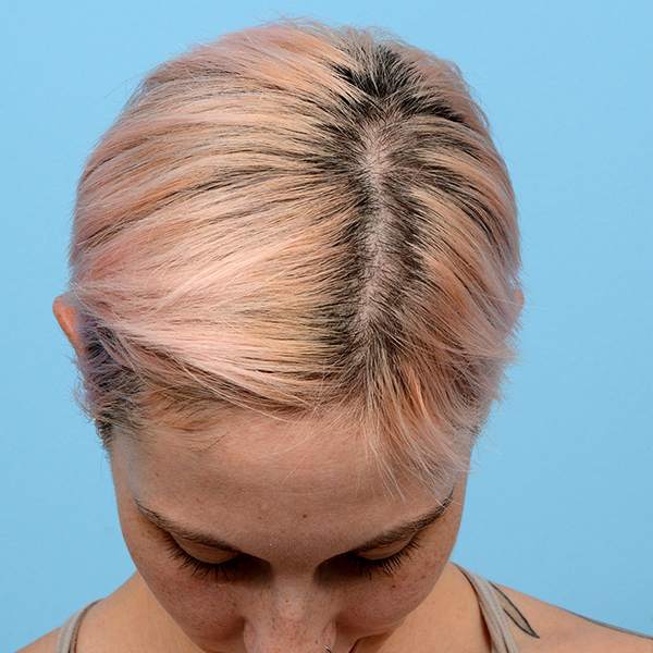 Fue Before and After | Dr. Jeffrey Wise