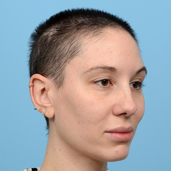 Fue Before and After | Dr. Jeffrey Wise