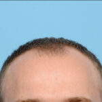 Fue Before and After | Dr. Jeffrey Wise