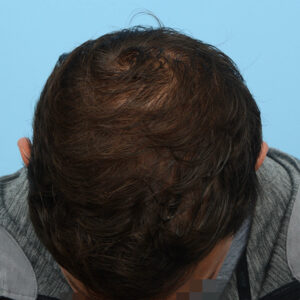 Fue Before and After | Dr. Jeffrey Wise