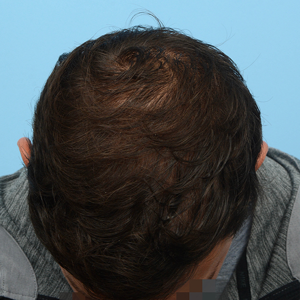 Fue Before and After | Dr. Jeffrey Wise