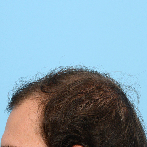 Fue Before and After | Dr. Jeffrey Wise