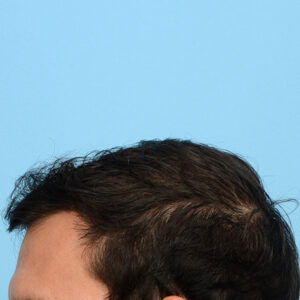 Fue Before and After | Dr. Jeffrey Wise