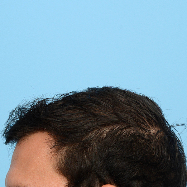 Fue Before and After | Dr. Jeffrey Wise