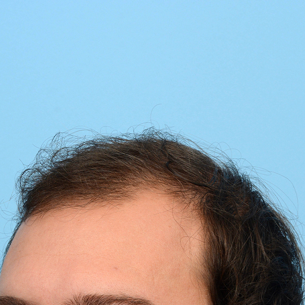 Fue Before and After | Dr. Jeffrey Wise