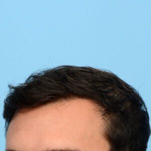 Fue Before and After | Dr. Jeffrey Wise