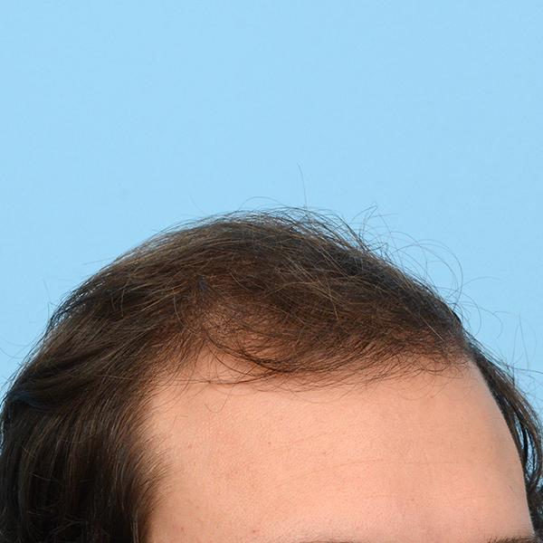 Fue Before and After | Dr. Jeffrey Wise