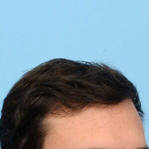 Fue Before and After | Dr. Jeffrey Wise