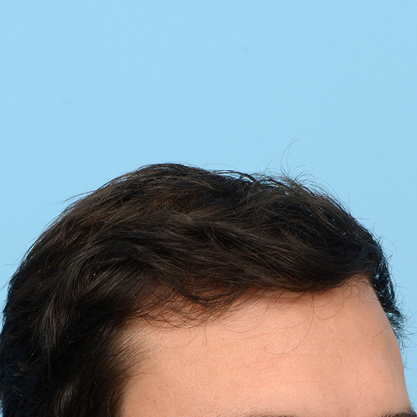 Fue Before and After | Dr. Jeffrey Wise