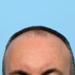 Fue Before and After | Dr. Jeffrey Wise