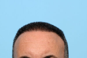 Fue Before and After | Dr. Jeffrey Wise