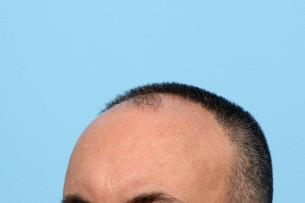 Fue Before and After | Dr. Jeffrey Wise