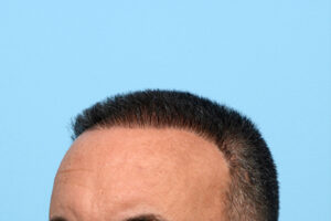 Fue Before and After | Dr. Jeffrey Wise