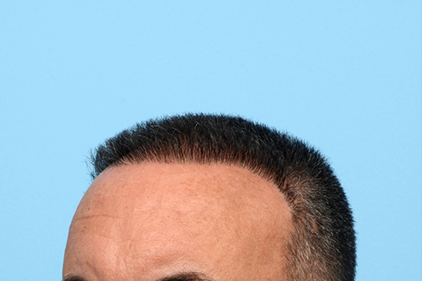 Fue Before and After | Dr. Jeffrey Wise