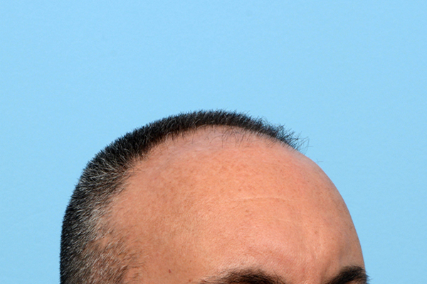 Fue Before and After | Dr. Jeffrey Wise