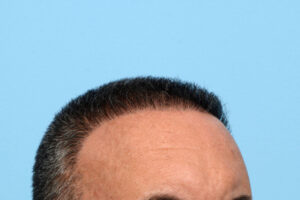 Fue Before and After | Dr. Jeffrey Wise